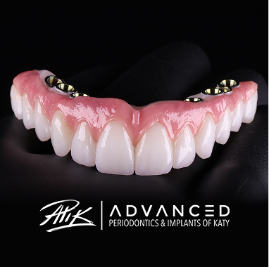 Hybrid Implant Bridge