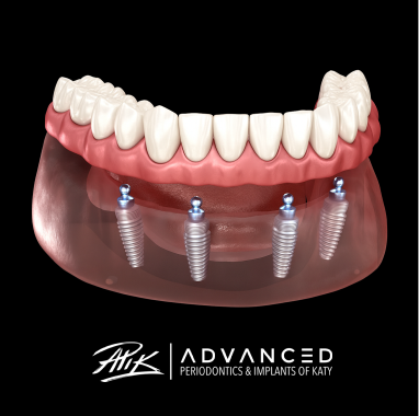 Zirconia Implant Bridge
