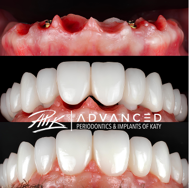 Porcelain Implant Bridge